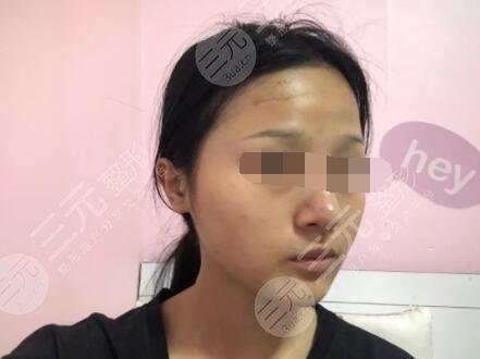 像素激光祛疤后一个月