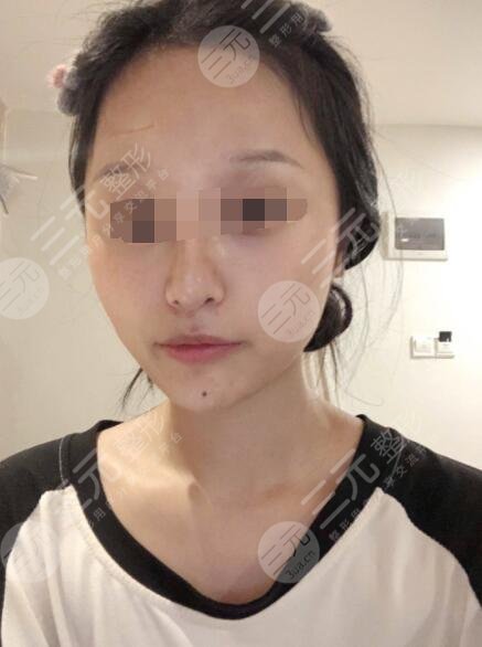 像素激光祛疤后3个月