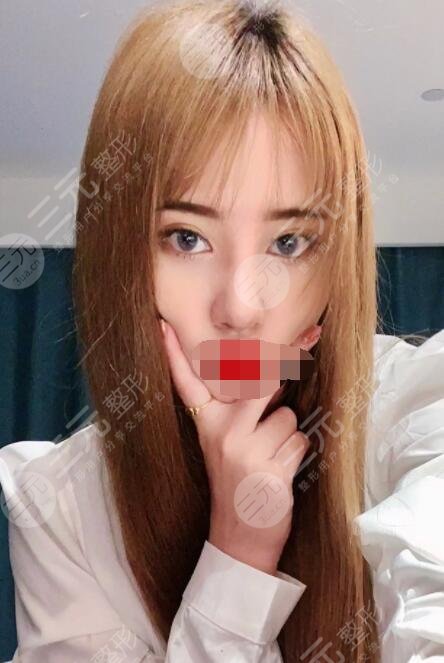 胶原蛋白隆鼻后