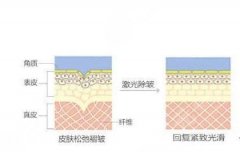 激光除皱的价格多少钱？费用分析&果图预览，值得pick！