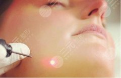 激光缓解痘疤有吗？原理&果图分享，痘肌の美肤攻略！