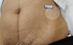 妊娠纹激光手术前后对比果明X吗？看了真人案例果就知道了！