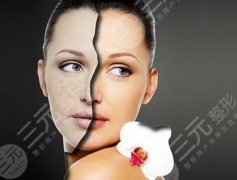 光子祛斑价格一览表，光子祛斑的注意事项+光子祛斑的真实案例