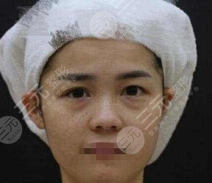 光子祛斑前