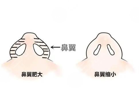 鼻翼过宽整容果照,鼻翼过宽缩小手术注意事项+真实果