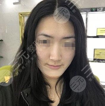 垫下巴手术后一周