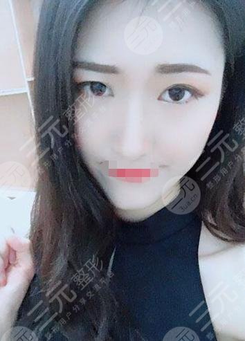 垫下巴手术后9周