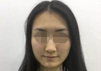 垫下巴手术前