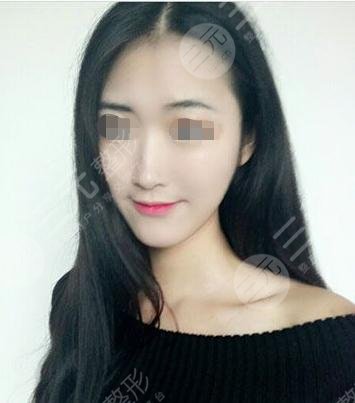 垫下巴手术后3周