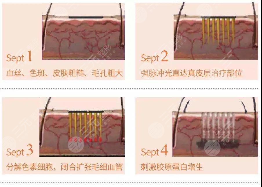 复合彩光去红血丝的过程