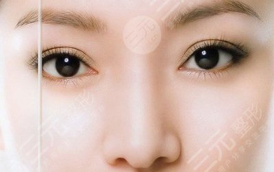 玻尿酸丰卧蚕会下垂吗