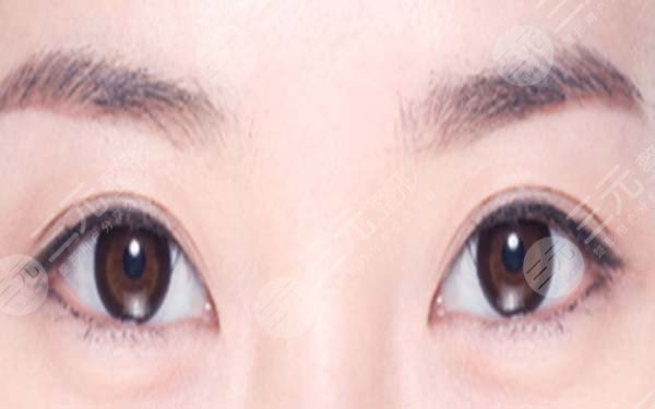 玻尿酸丰卧蚕会下垂吗