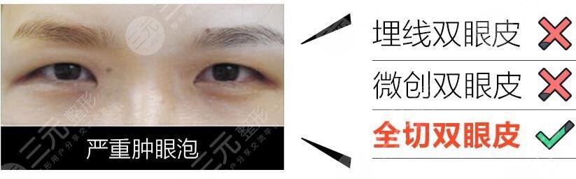 北京做个双眼皮多少钱