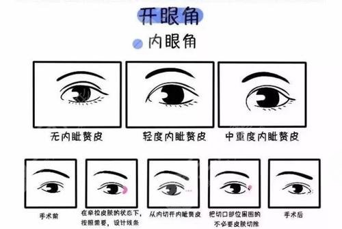 开内眼角