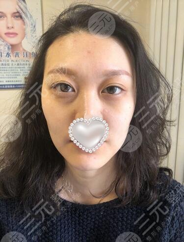 激光除皱整形案例