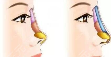 假体隆鼻果好么