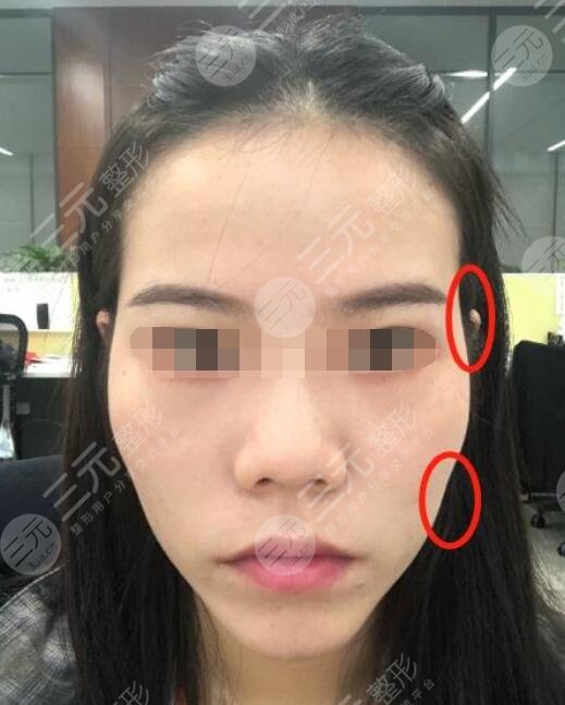 玻尿酸丰太阳穴多少钱