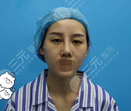 自体软骨隆鼻前