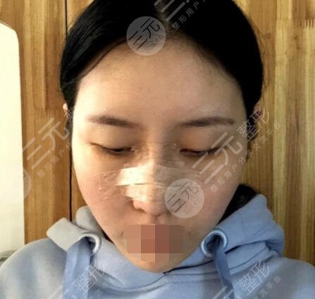 自体软骨隆鼻后6天