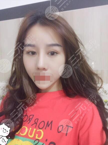 自体软骨隆鼻后46天