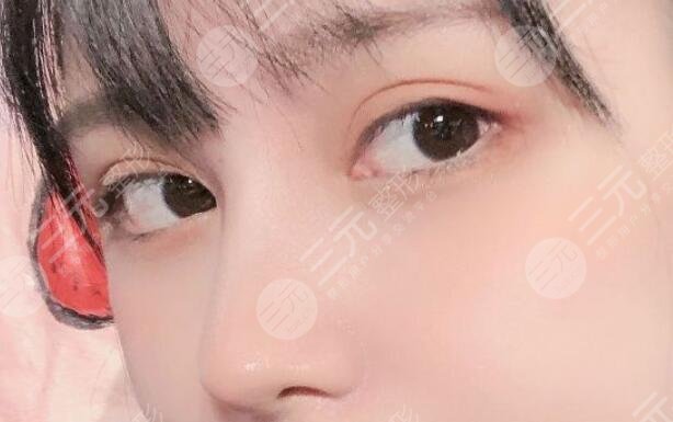 耳软骨隆鼻注意事项