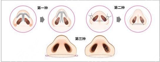 鼻孔缩小手术