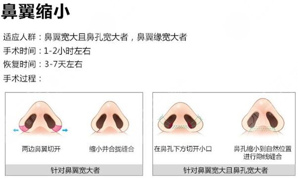 鼻翼过宽整容