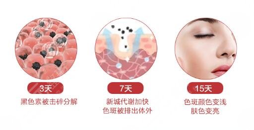 光子祛斑手术后注意事项