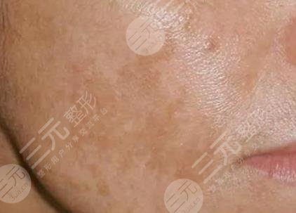 去除黄褐斑后注意事项