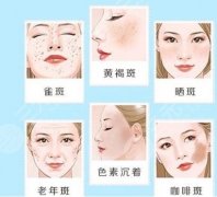 祛斑大概多少钱？激光祛斑的费用|术后护理注意事项