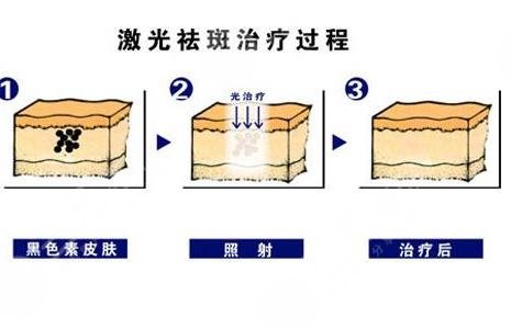激光祛斑的费用