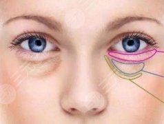 去眼袋有的方法是什么？去眼袋手术的注意事项有哪些？