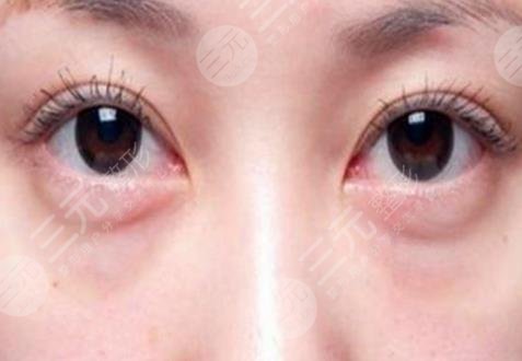 去眼袋有的方法是什么