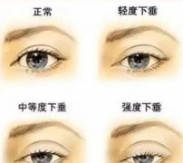 上睑下垂怎么办？可以做手术吗？上睑下垂的类型有哪些？