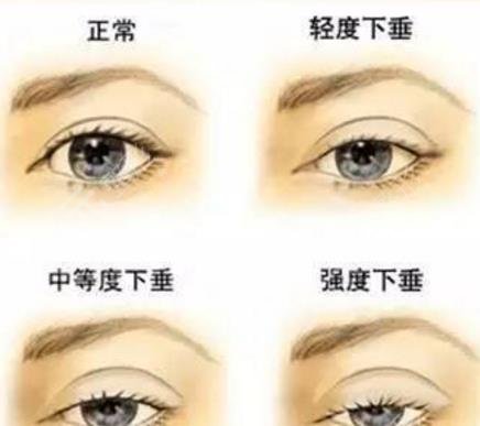 上睑下垂怎么办?可以做手术吗?上睑下垂的类型有哪些?