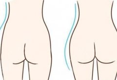 臀部下垂怎么办？臀部下垂矫正提臀手术的相关解析~