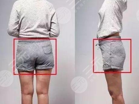 臀部下垂怎么办