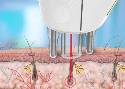 激光脱毛的危害