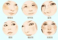彩光缓解黄褐斑原理是怎样的？彩光缓解黄褐斑注意事项须知！