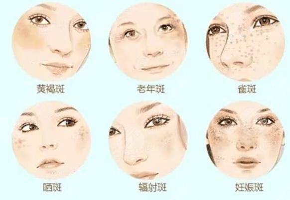 彩光缓解黄褐斑原理是怎样的？彩光缓解黄褐斑注意事项须知！