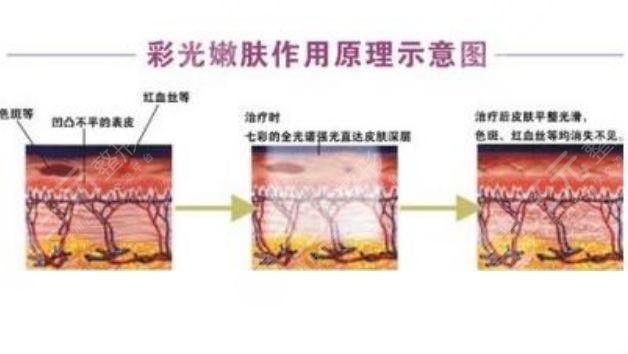 彩光缓解黄褐斑原理是怎样的