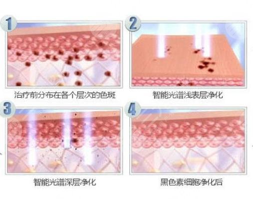 彩光缓解黄褐斑术后注意事项: