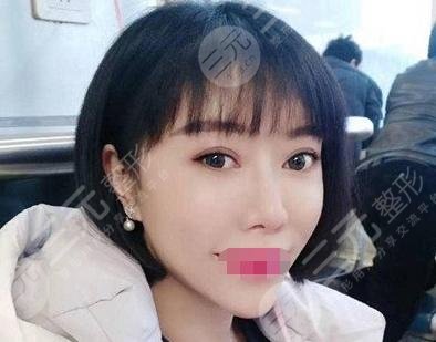 V美减龄后3个月