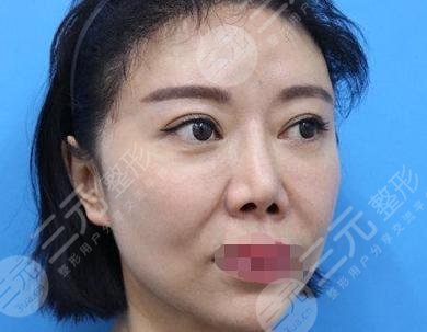 V美减龄前