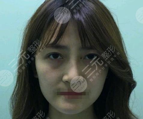 V美减龄前