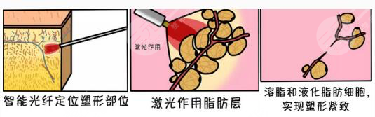 光纤溶脂原理介绍