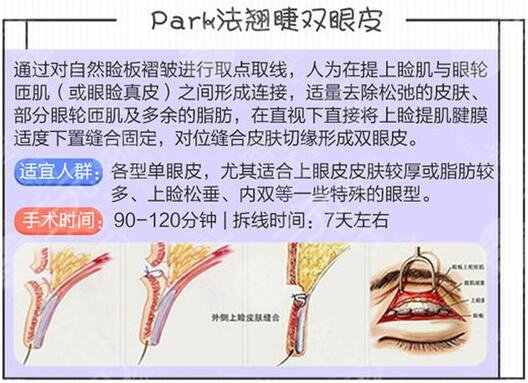 翘睫术双眼皮成好吗
