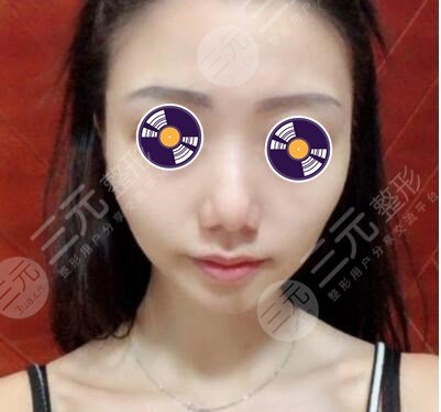 自体脂肪垫下巴前