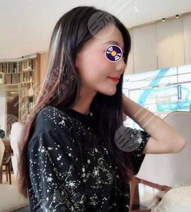 自体脂肪垫下巴后一个月