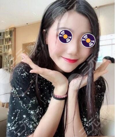 自体脂肪垫下巴后4个月